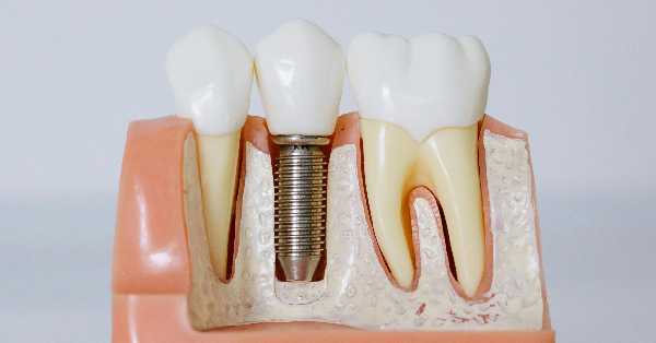 5 Key Signs You Need Dental Implants in Washington