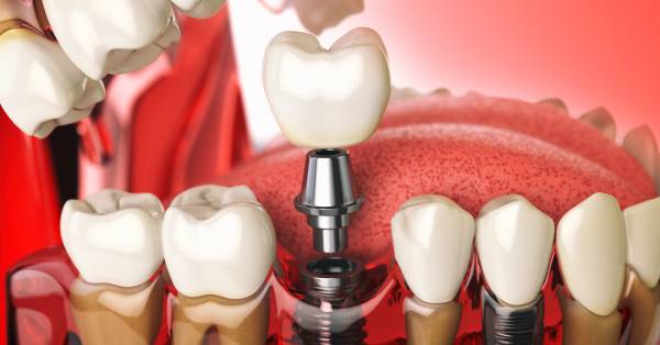 5 Nutrition Tips Post-Dental Implants in Washington