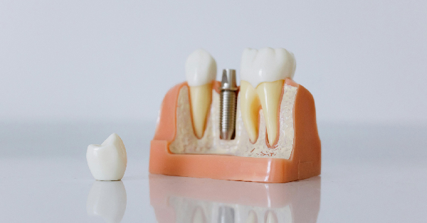 Discover 4 Different Types of Dental Implants in Washington